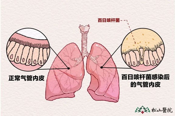 百日咳桿菌感染。重慶松山醫(yī)院供圖