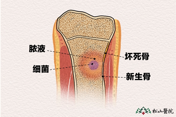 骨髓炎示意圖。重慶松山醫(yī)院供圖