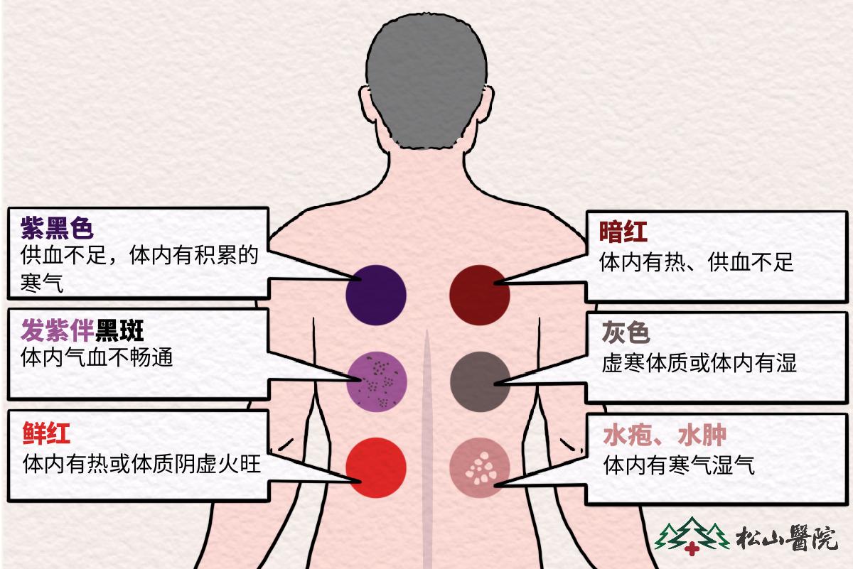 拔罐不同顏色說(shuō)明的問(wèn)題。重慶松山醫(yī)院供圖