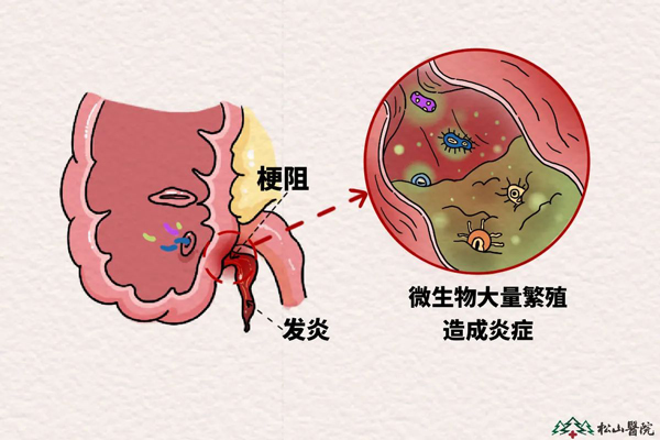 闌尾發(fā)炎示意圖。重慶松山醫(yī)院供圖